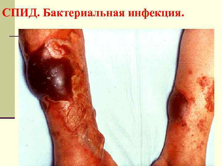 СПИД. Бактериальная инфекция. 