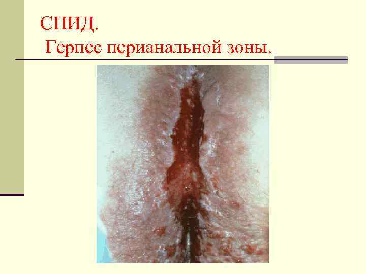 СПИД. Герпес перианальной зоны. 