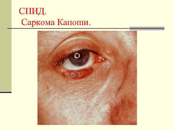 СПИД. Саркома Капоши. 