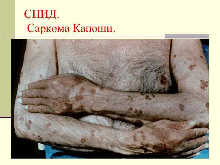СПИД. Саркома Капоши. 