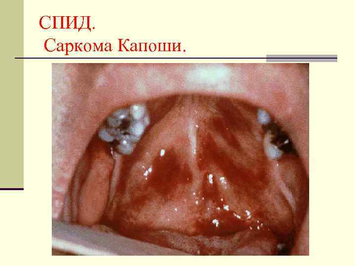 СПИД. Саркома Капоши. 