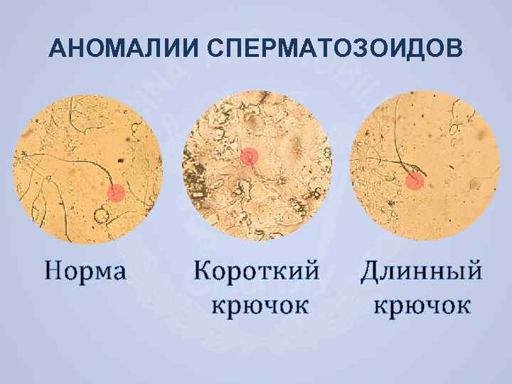 Некрозооспермия. Аномалии сперматозоидов. Аномальные формы спермограмма. Спермограмма с аномальными сперматозоидами.