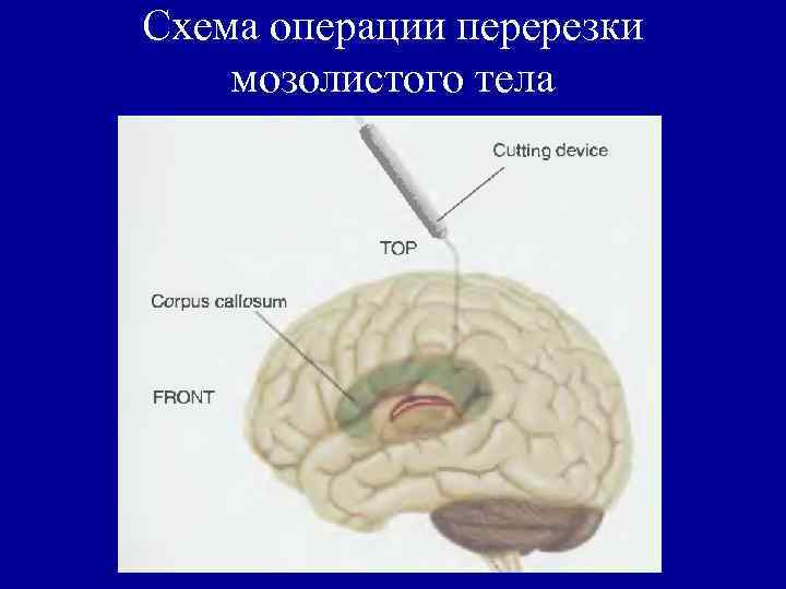 Схема операции перерезки мозолистого тела 