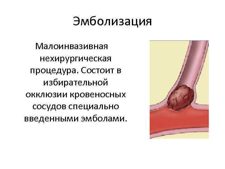 Эмболизация Малоинвазивная нехирургическая процедура. Состоит в избирательной окклюзии кровеносных сосудов специально введенными эмболами. 