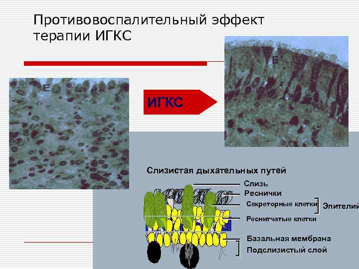 Противовоспалительный эффект терапии ИГКС Слизистая дыхательных путей Слизь Реснички Секреторные клетки Эпителий Реснитчатые клетки