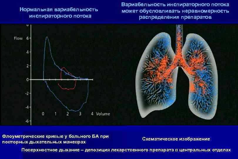 Нормальная вариабельность инспираторного потока Флоуметрические кривые у больного БА при повторных дыхательных маневрах Вариабельность