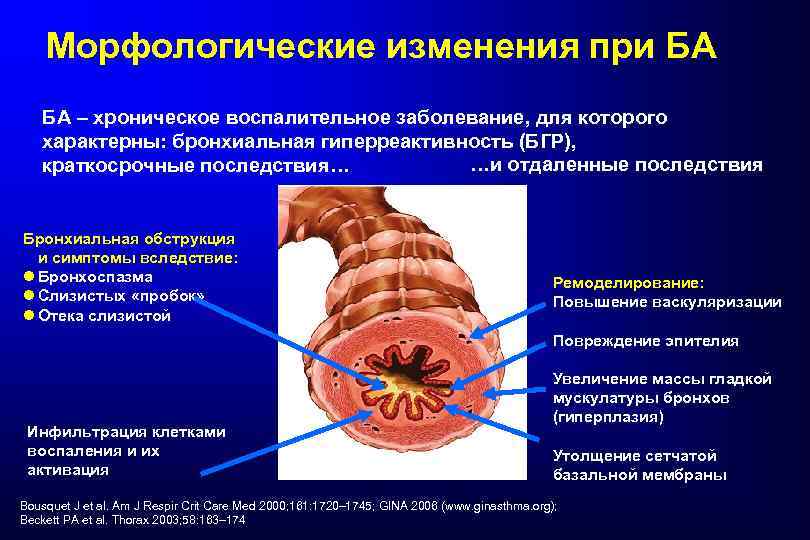 Морфологические изменения при БА БА – хроническое воспалительное заболевание, для которого характерны: бронхиальная гиперреактивность