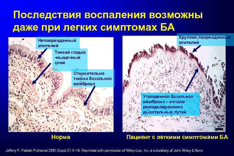 Последствия воспаления возможны даже при легких симптомах БА Неповрежденный эпителий Хрупкий, поврежденный эпителий Тонкий