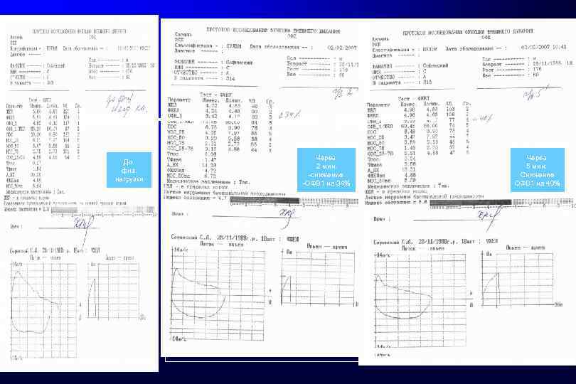 До физ. нагрузки Через 2 мин. -снижение -ОФВ 1 на 34% Через 5 мин: