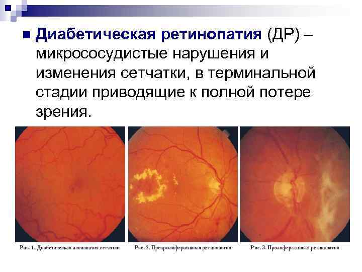 Изменение глазного дна при сахарном диабете презентация