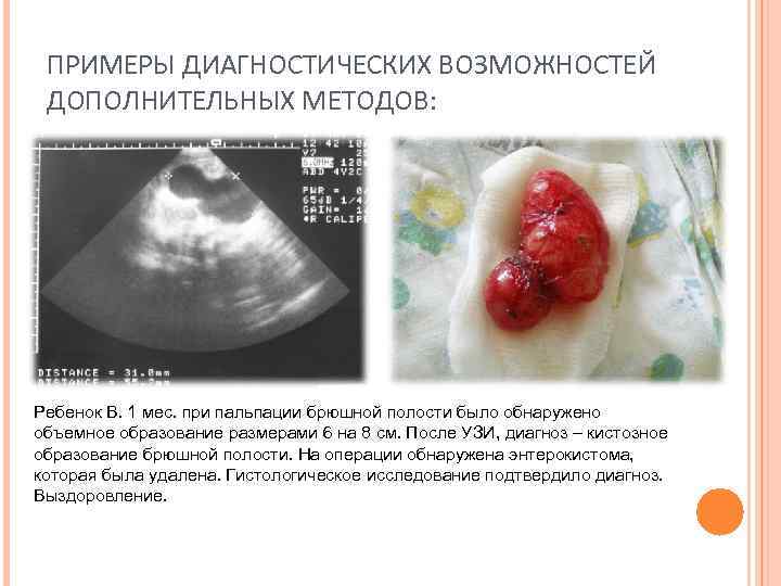 ПРИМЕРЫ ДИАГНОСТИЧЕСКИХ ВОЗМОЖНОСТЕЙ ДОПОЛНИТЕЛЬНЫХ МЕТОДОВ: Ребенок В. 1 мес. при пальпации брюшной полости было