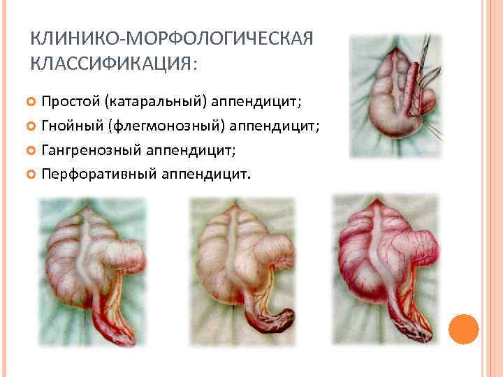 КЛИНИКО-МОРФОЛОГИЧЕСКАЯ КЛАССИФИКАЦИЯ: Простой (катаральный) аппендицит; Гнойный (флегмонозный) аппендицит; Гангренозный аппендицит; Перфоративный аппендицит. 