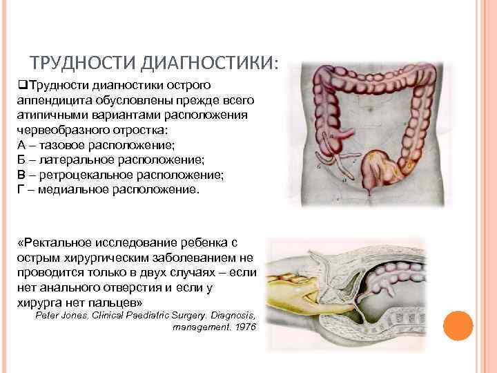 ТРУДНОСТИ ДИАГНОСТИКИ: q. Трудности диагностики острого аппендицита обусловлены прежде всего атипичными вариантами расположения червеобразного