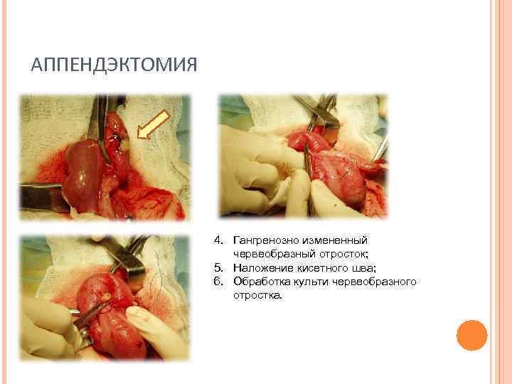 АППЕНДЭКТОМИЯ 4. Гангренозно измененный червеобразный отросток; 5. Наложение кисетного шва; 6. Обработка культи червеобразного