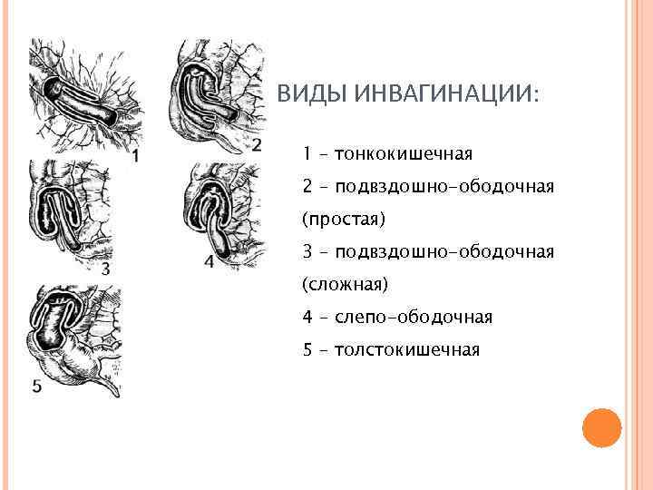 ВИДЫ ИНВАГИНАЦИИ: 1 – тонкокишечная 2 – подвздошно-ободочная (простая) 3 – подвздошно-ободочная (сложная) 4