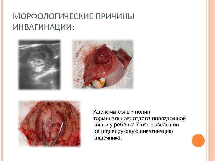 МОРФОЛОГИЧЕСКИЕ ПРИЧИНЫ ИНВАГИНАЦИИ: Аденоматозный полип терминального отдела подвздошной кишки у ребенка 7 лет вызвавший