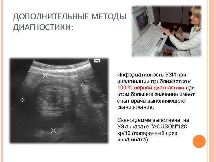 ДОПОЛНИТЕЛЬНЫЕ МЕТОДЫ ДИАГНОСТИКИ: Информативность УЗИ при инвагинации приближается к 100 % верной диагностики при