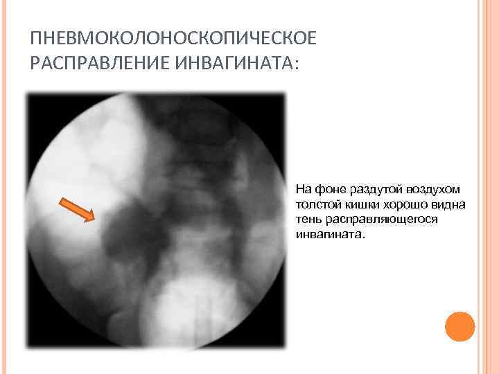 ПНЕВМОКОЛОНОСКОПИЧЕСКОЕ РАСПРАВЛЕНИЕ ИНВАГИНАТА: На фоне раздутой воздухом толстой кишки хорошо видна тень расправляющегося инвагината.