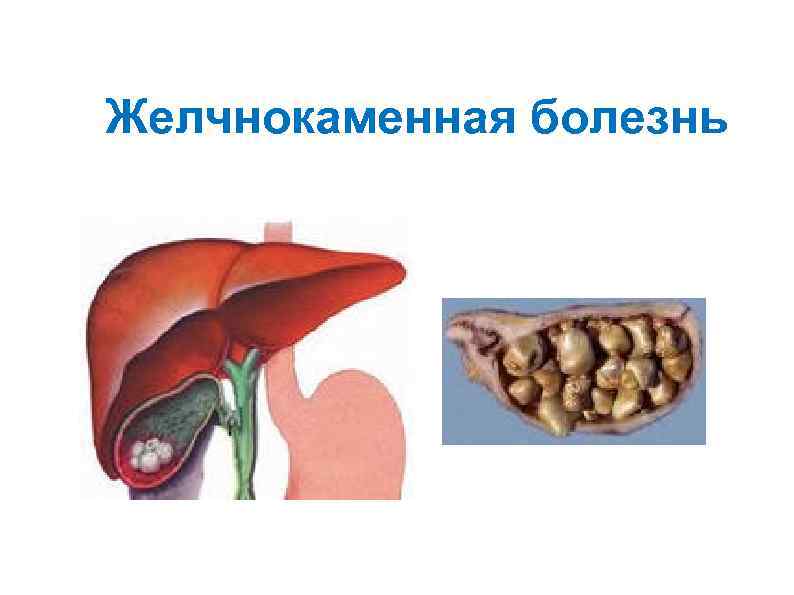 Желчнокаменная болезнь 