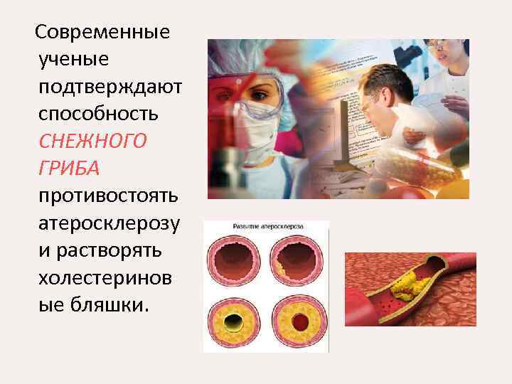  Современные ученые подтверждают способность СНЕЖНОГО ГРИБА противостоять атеросклерозу и растворять холестеринов ые бляшки.