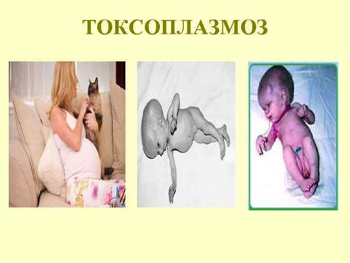 ТОКСОПЛАЗМОЗ 