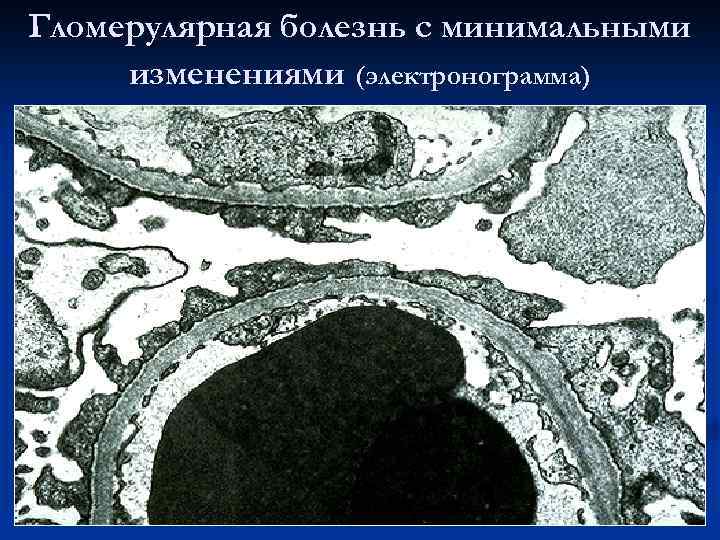 Гломерулярная болезнь с минимальными изменениями (электронограмма) 