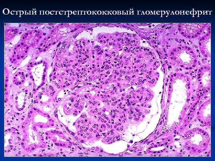Острый постстрептококковый гломерулонефрит 
