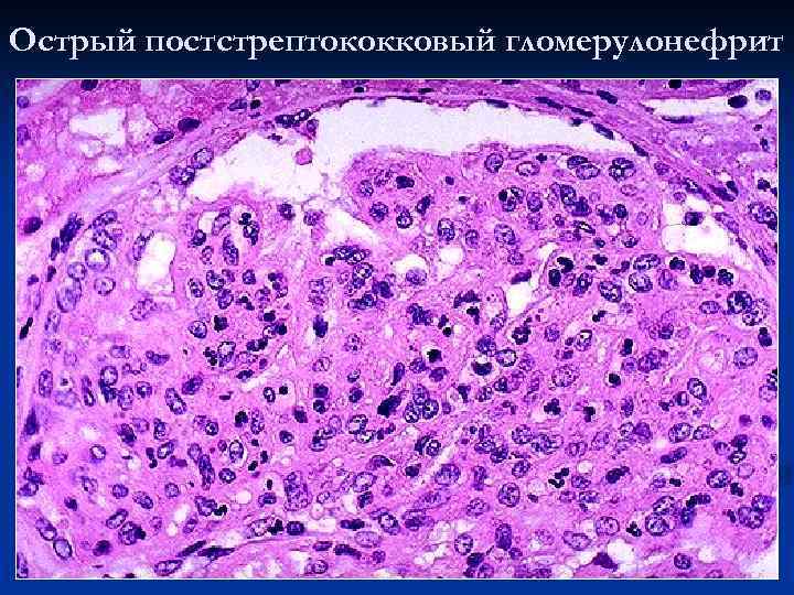 Острый постстрептококковый гломерулонефрит 