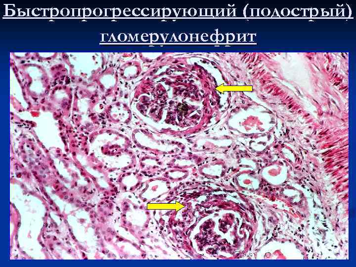 Быстропрогрессирующий (подострый) гломерулонефрит 