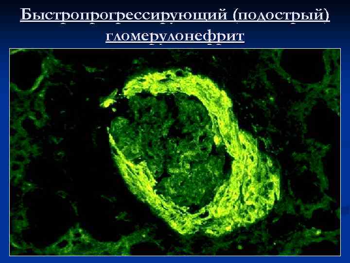 Быстропрогрессирующий (подострый) гломерулонефрит 