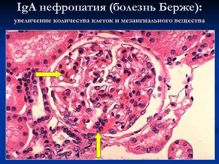 Ig. A нефропатия (болезнь Берже): увеличение количества клеток и мезангиального вещества 