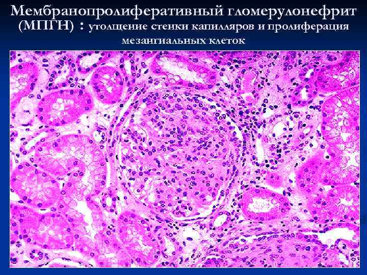 Мембранопролиферативный гломерулонефрит (МПГН) : утолщение стенки капилляров и пролиферация мезангиальных клеток 