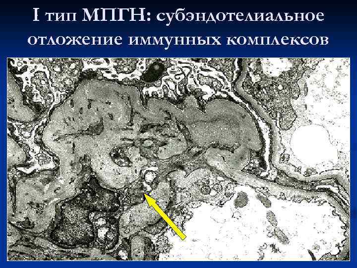 I тип МПГН: субэндотелиальное отложение иммунных комплексов 