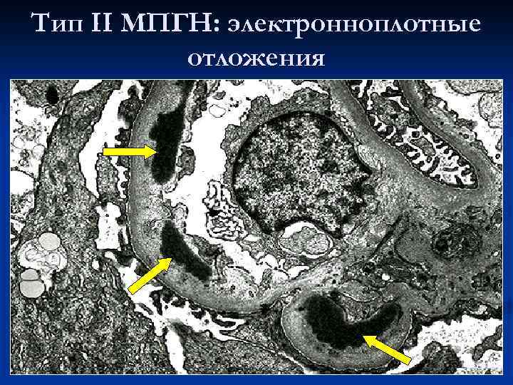 Тип II МПГН: электронноплотные отложения 