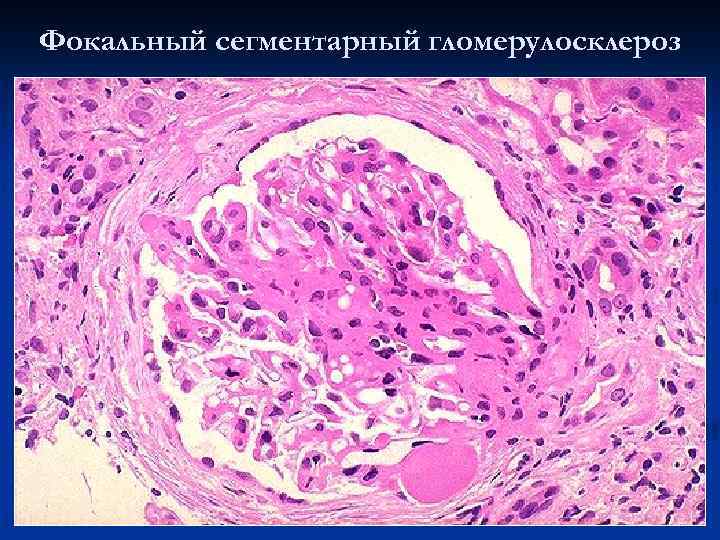 Фокальный сегментарный гломерулосклероз 