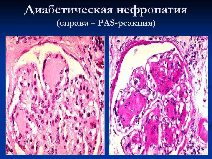 Диабетическая нефропатия (справа – PAS-реакция) 