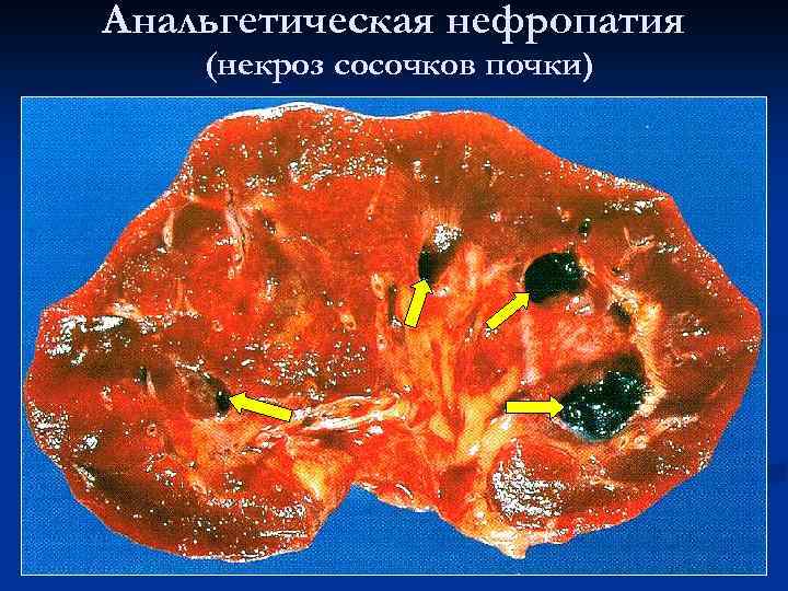 Анальгетическая нефропатия (некроз сосочков почки) 