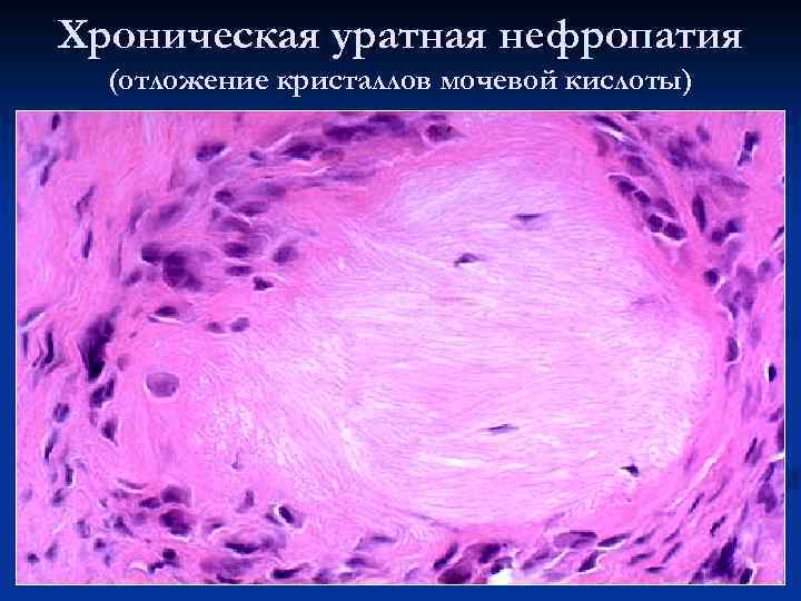 Хроническая уратная нефропатия (отложение кристаллов мочевой кислоты) 