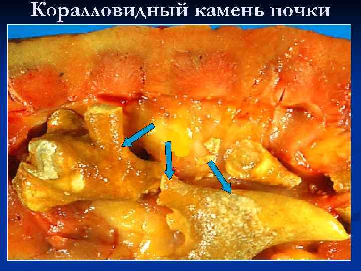 Коралловидный камень почки 