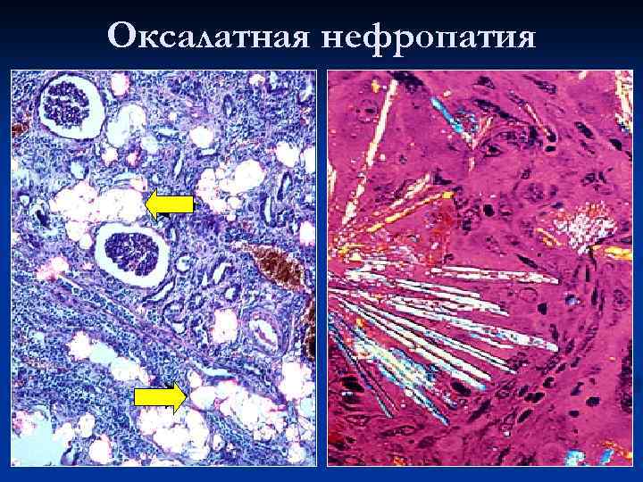 Оксалатная нефропатия 
