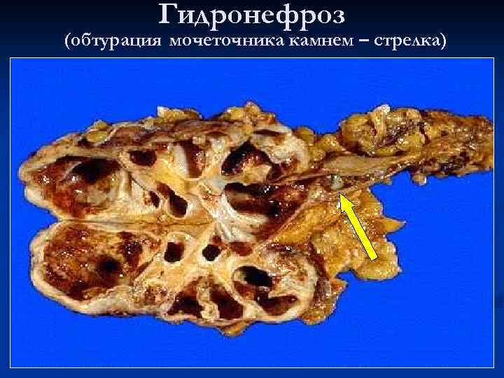 Гидронефроз (обтурация мочеточника камнем – стрелка) 