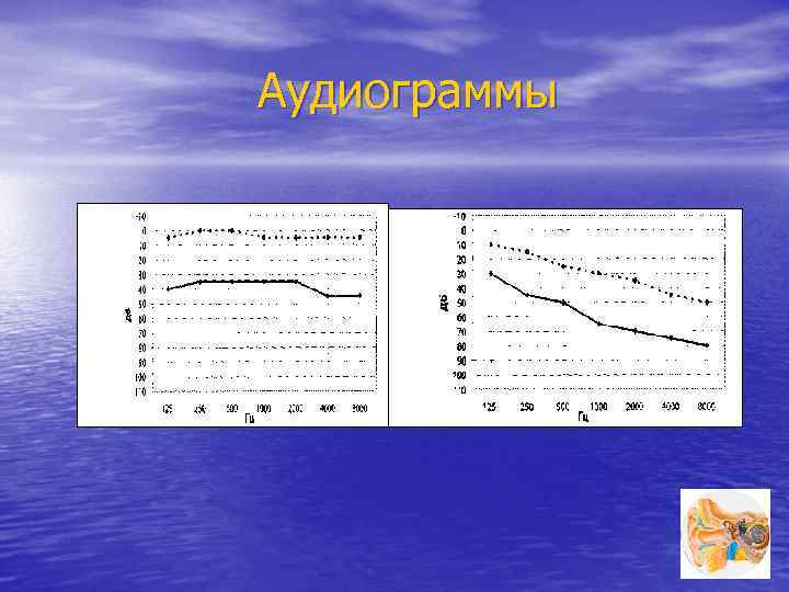 Аудиограммы 