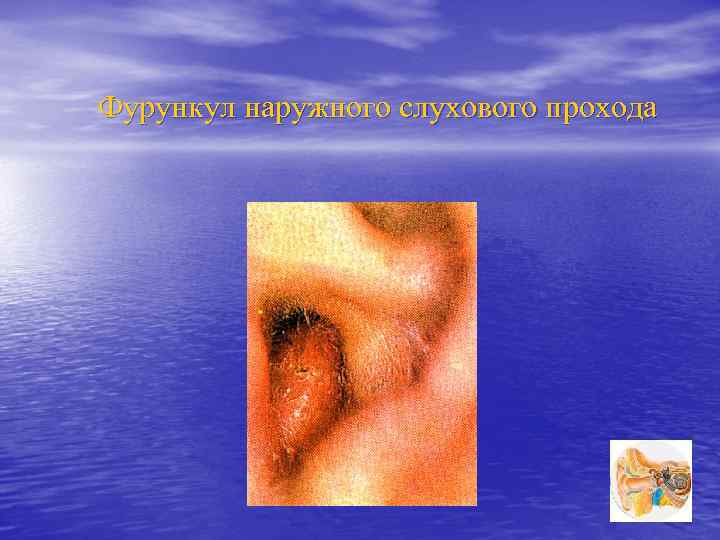 Фурункул наружного слухового прохода 