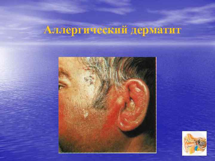 Аллергический дерматит 