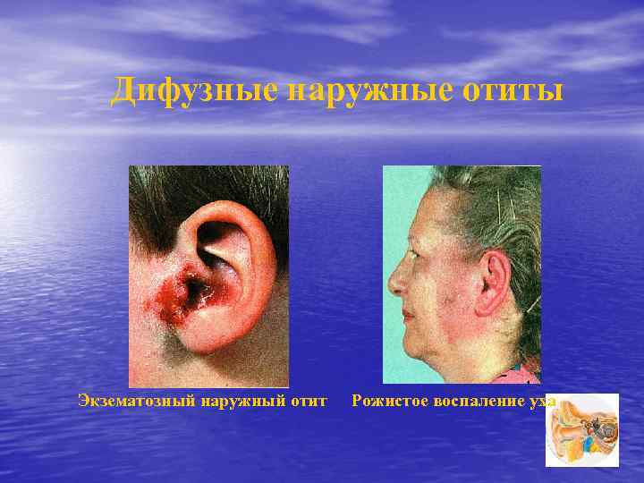 Дифузные наружные отиты Экзематозный наружный отит Рожистое воспаление уха 