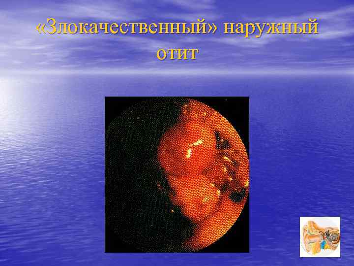  «Злокачественный» наружный отит 
