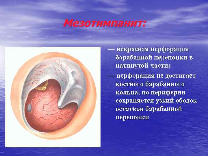 Мезотимпанит: — некраевая перфорация барабанной перепонки в натянутой части; — перфорация не достигает костного