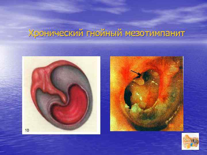 Хронический гнойный мезотимпанит 