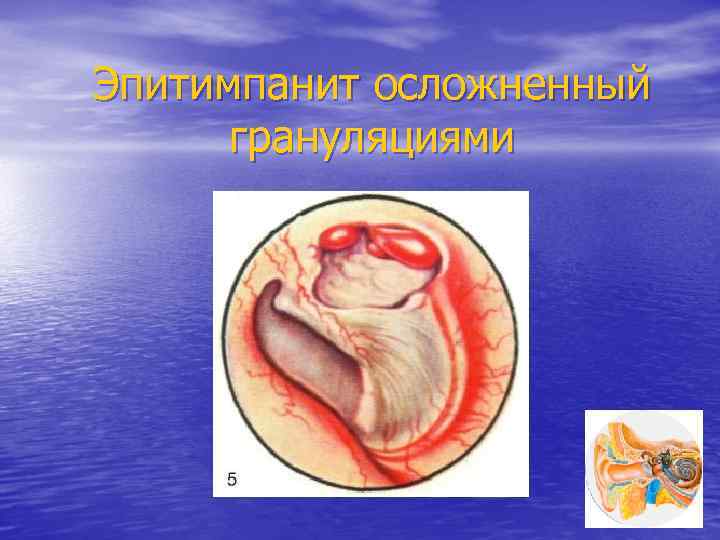 Эпитимпанит осложненный грануляциями 
