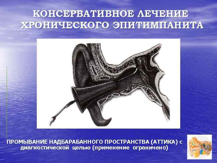 КОНСЕРВАТИВНОЕ ЛЕЧЕНИЕ ХРОНИЧЕСКОГО ЭПИТИМПАНИТА ПРОМЫВАНИЕ НАДБАРАБАННОГО ПРОСТРАНСТВА (АТТИКА) с диагностической целью (применение ограничено) 